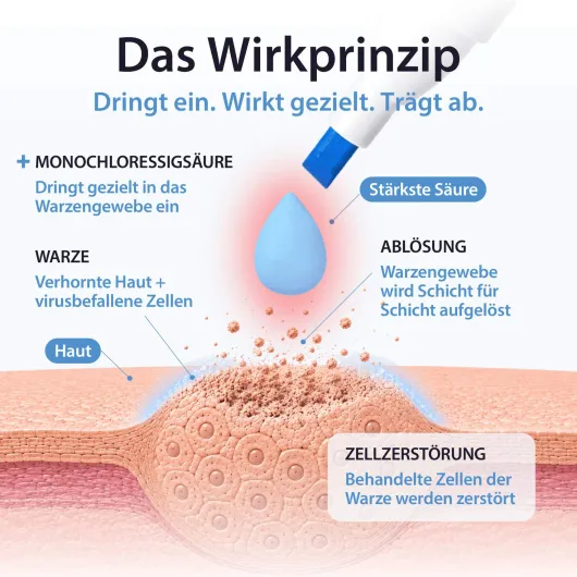 Acetocaustin Stift gegen Warzen 3 ml