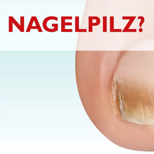 Miclast 80 mg pro g wirkstoffhaltiger Nagellack 3 ml