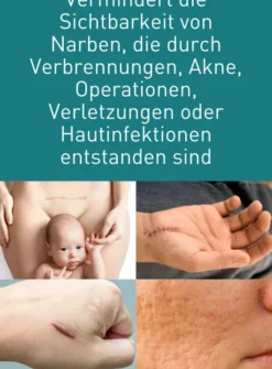 N1 Narben Gel 19 G